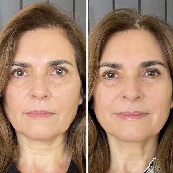 Antes e depois Lumielle 3