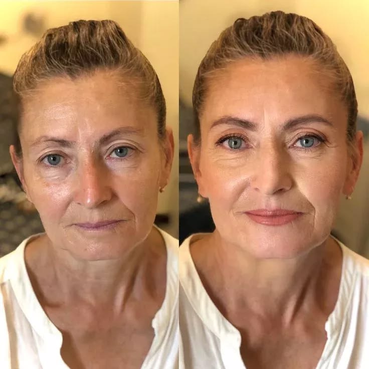 Antes e depois Lumielle 5
